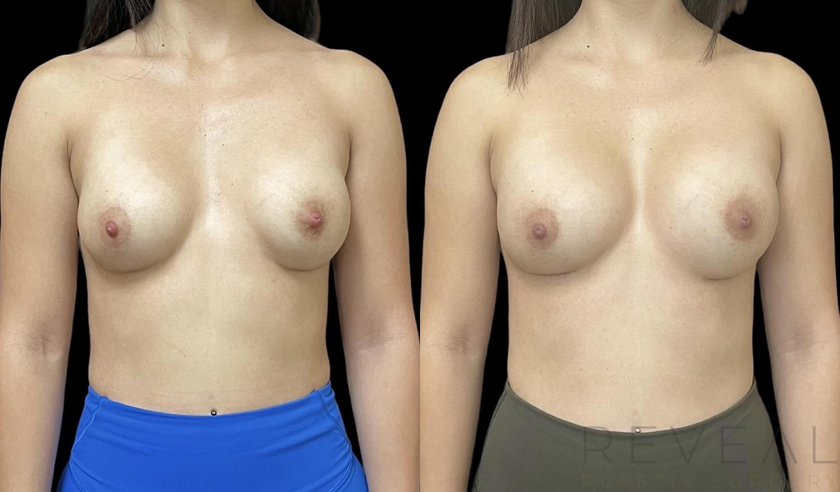 Before & After Breast Augmentation Case 711 Front View in San Jose, CA