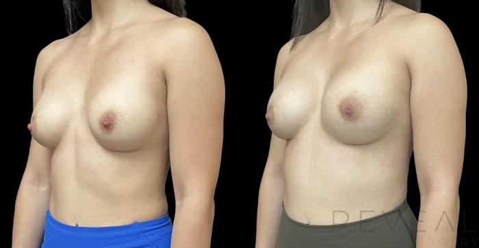 Before & After Breast Augmentation Case 711 Right Oblique View in San Jose, CA