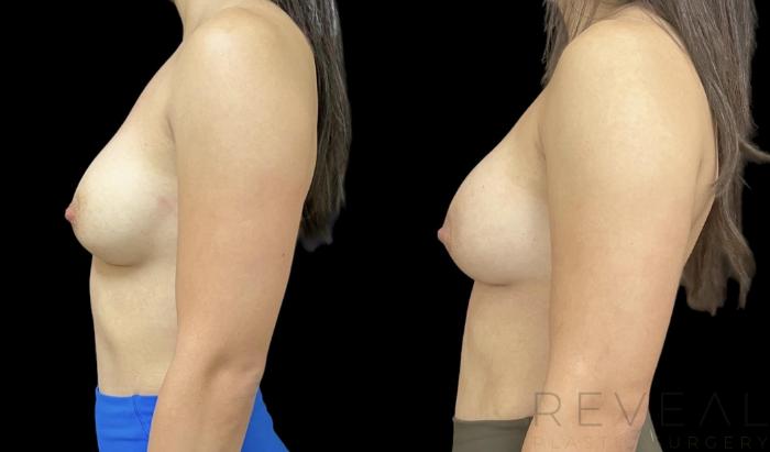 Before & After Breast Augmentation Case 711 Right Side View in San Jose, CA