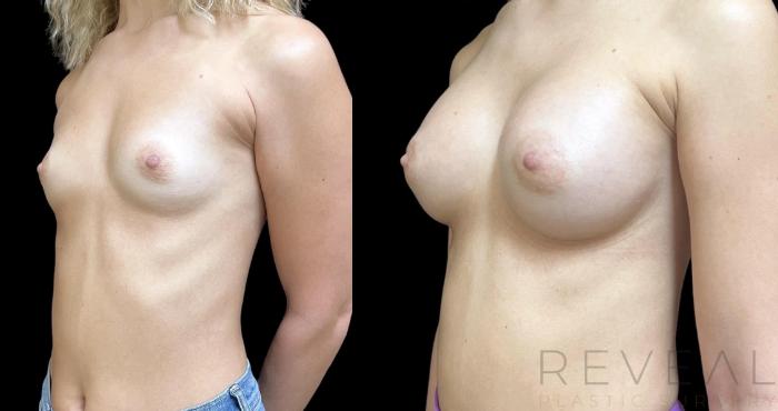 Before & After Breast Augmentation Case 712 Front View in San Jose, CA