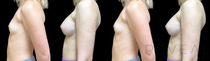 Before & After Breast Augmentation Case 712 Right Side View in San Jose, CA