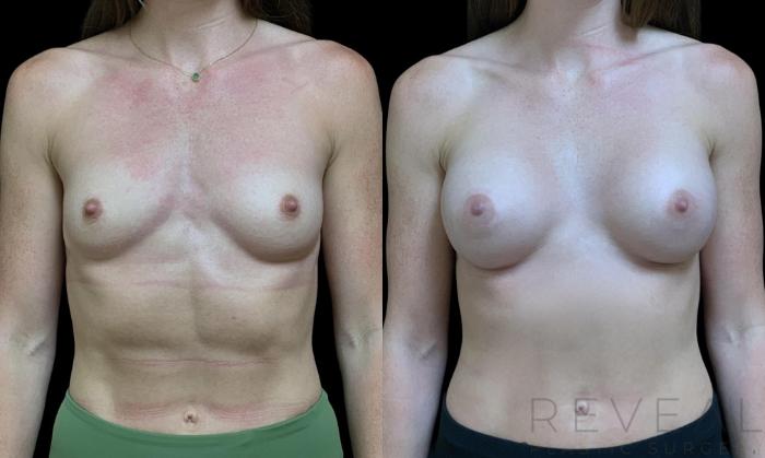 Before & After Breast Augmentation Case 713 Front View in San Jose, CA