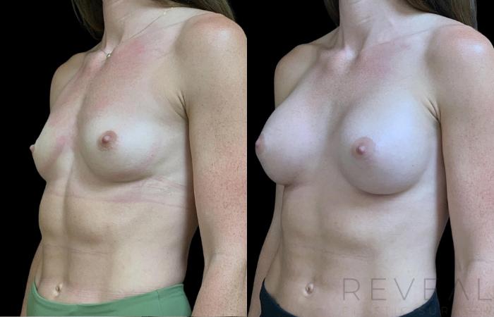 Before & After Breast Augmentation Case 713 Right Oblique View in San Jose, CA