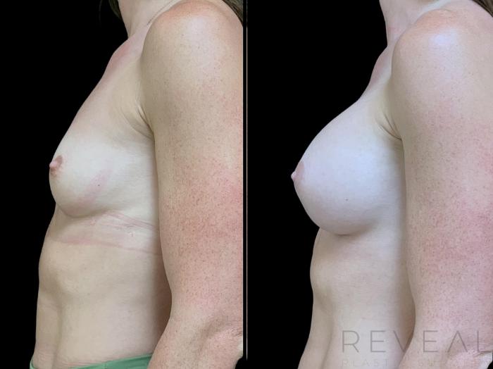 Before & After Breast Augmentation Case 713 Right Side View in San Jose, CA