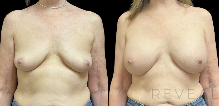 Before & After Breast Augmentation Case 718 Front View in San Jose, CA