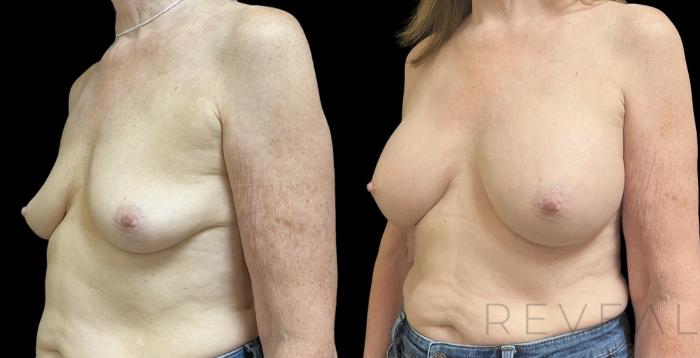 Before & After Breast Augmentation Case 718 Left Side View in San Jose, CA