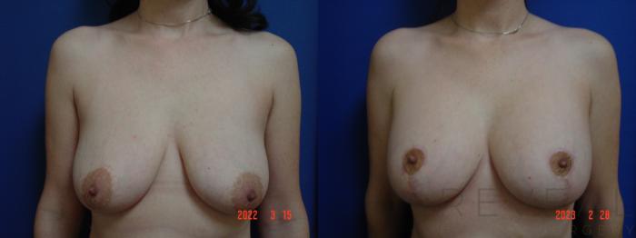 Before & After Breast Augmentation Case 721 Front View in San Jose, CA