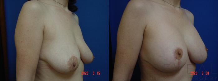 Before & After Breast Augmentation Case 721 Left Side View in San Jose, CA