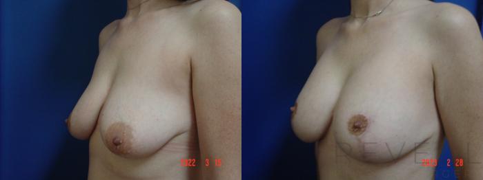 Before & After Breast Augmentation Case 721 Right Side View in San Jose, CA