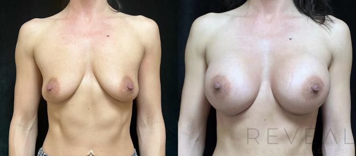 Before & After Breast Augmentation Case 723 Front View in San Jose, CA