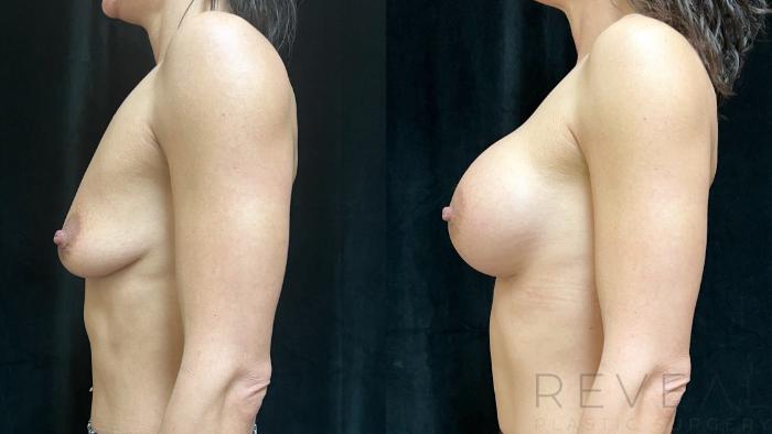 Before & After Breast Augmentation Case 723 Left Oblique View in San Jose, CA