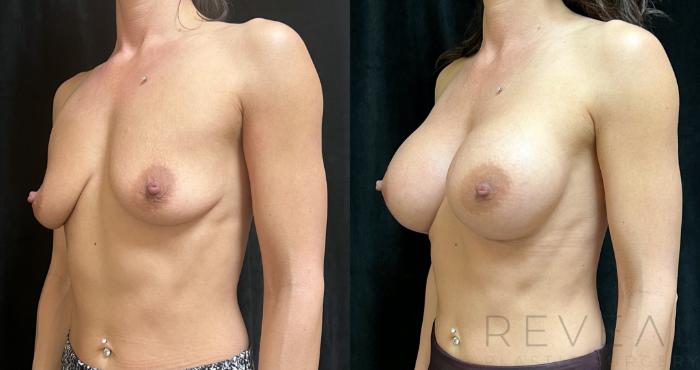 Before & After Breast Augmentation Case 723 Left Side View in San Jose, CA