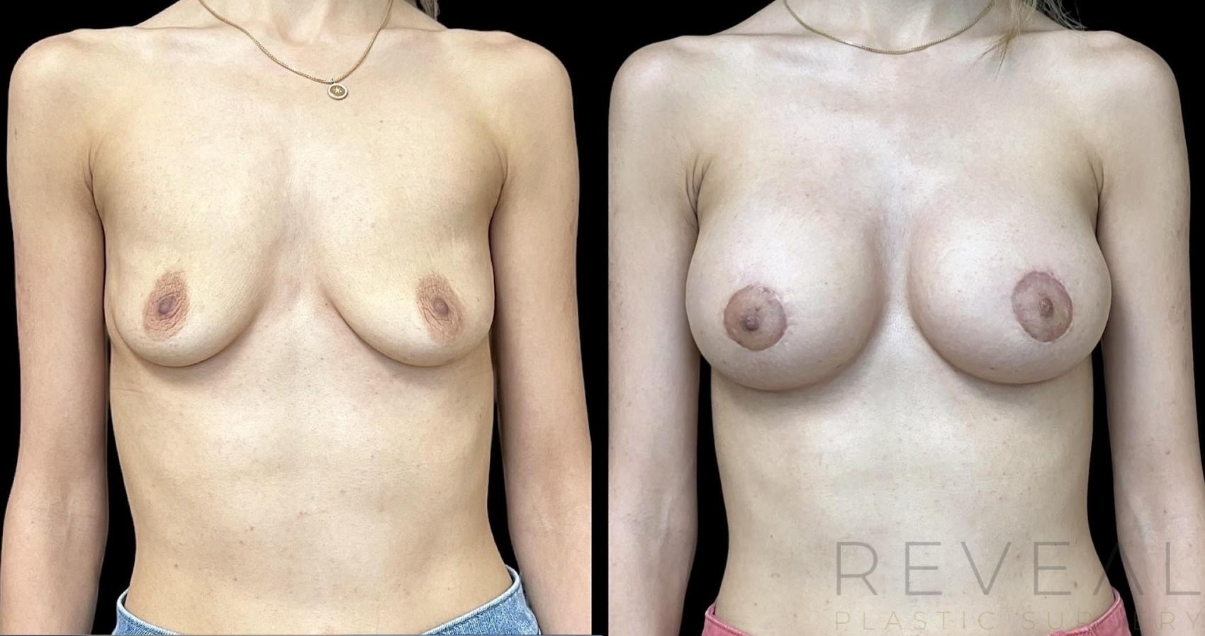 Before & After Breast Augmentation Case 726 Front View in San Jose, CA