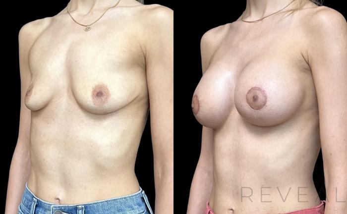 Before & After Breast Augmentation Case 726 Left Oblique View in San Jose, CA