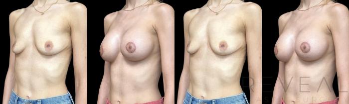 Before & After Breast Augmentation Case 726 Left Side View in San Jose, CA