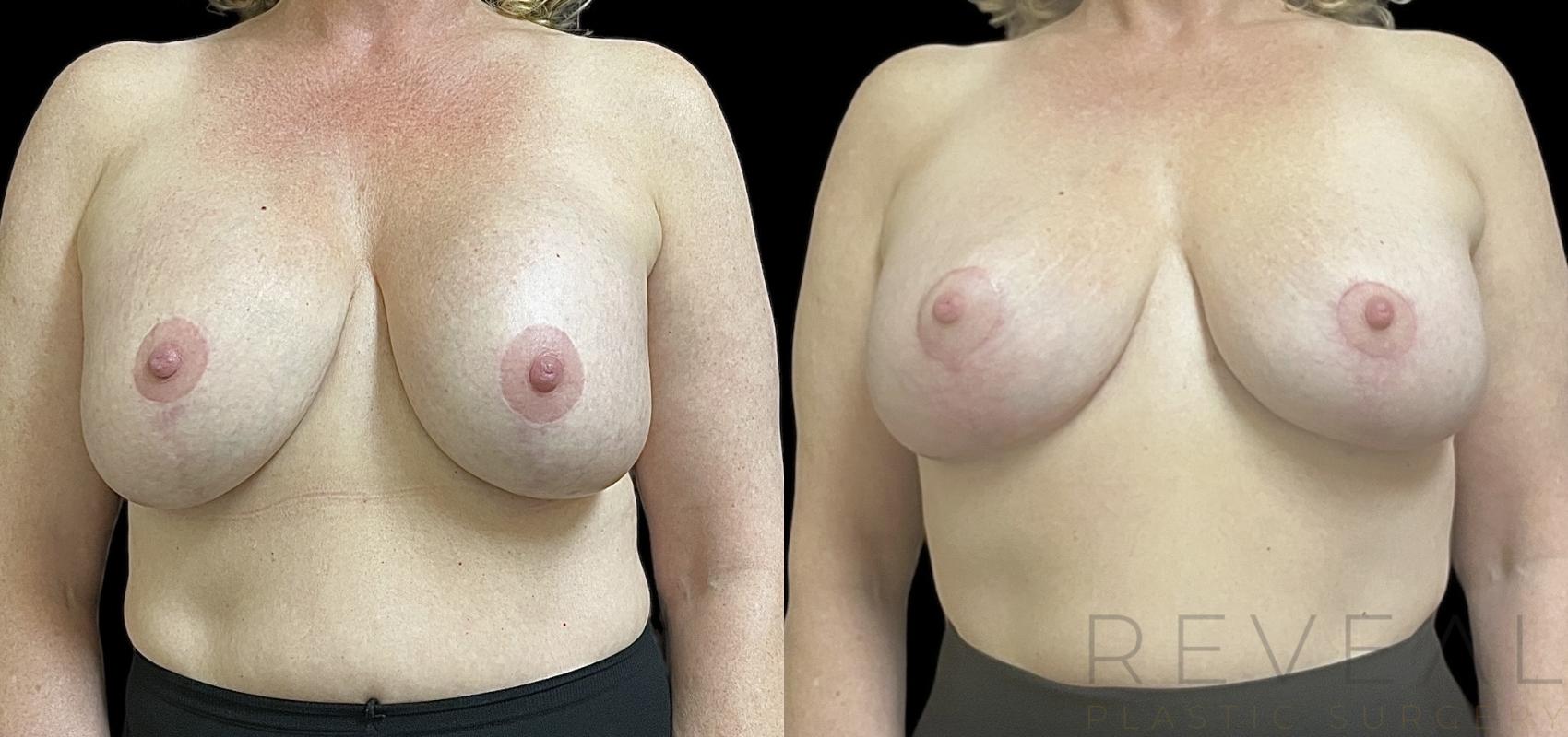 Before & After Breast Augmentation Case 732 Front View in San Jose, CA