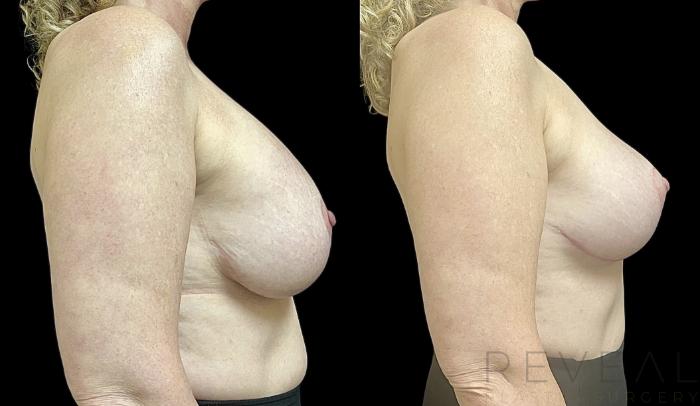 Before & After Breast Augmentation Case 732 Left Oblique View in San Jose, CA