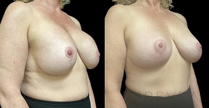 Before & After Breast Augmentation Case 732 Left Side View in San Jose, CA