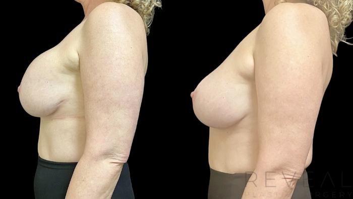 Before & After Breast Augmentation Case 732 Right Side View in San Jose, CA