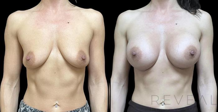 Before & After Breast Augmentation Case 739 Front View in San Jose, CA