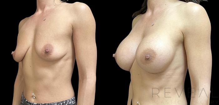 Before & After Breast Augmentation Case 739 Left Oblique View in San Jose, CA