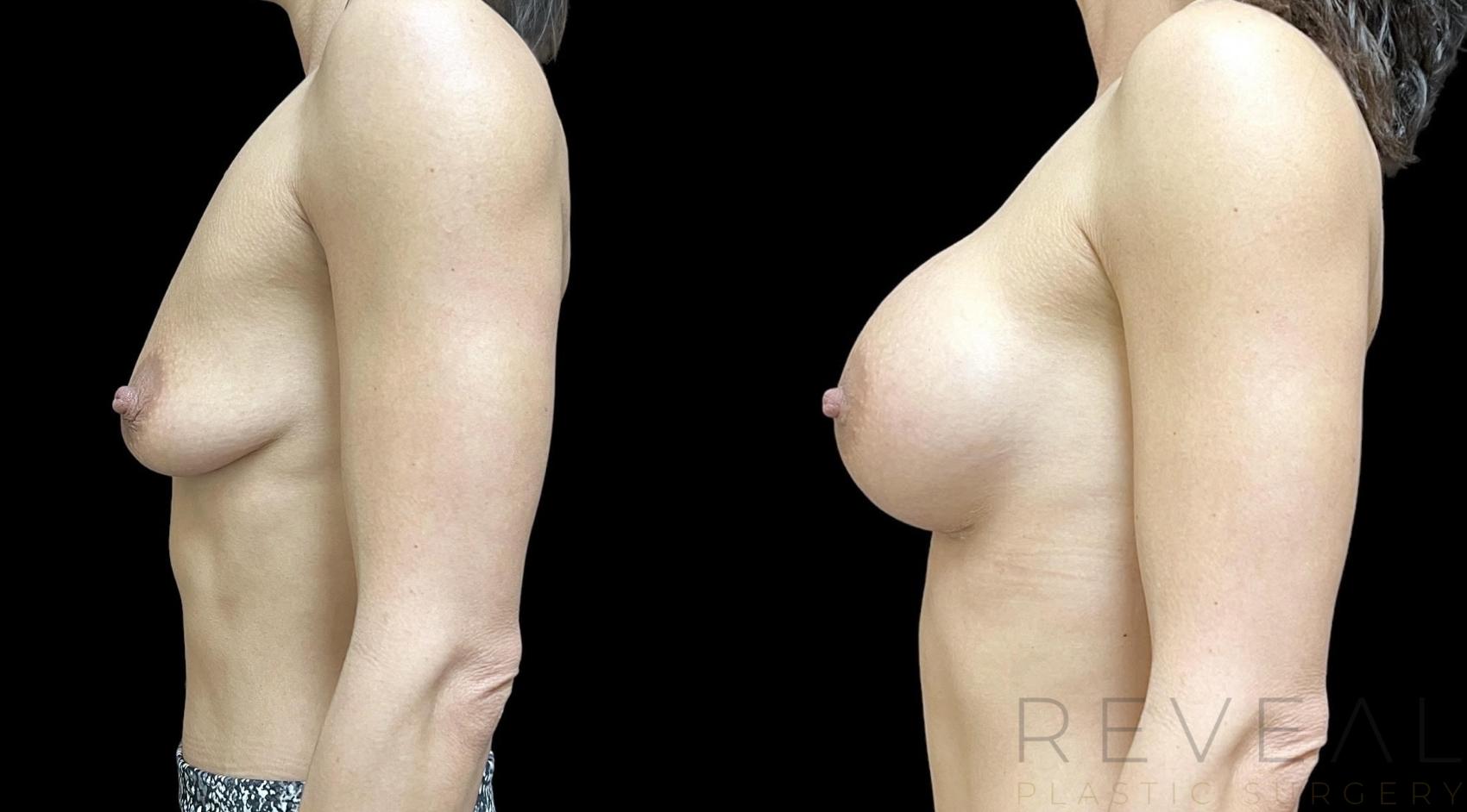 Before & After Breast Augmentation Case 739 Left Side View in San Jose, CA
