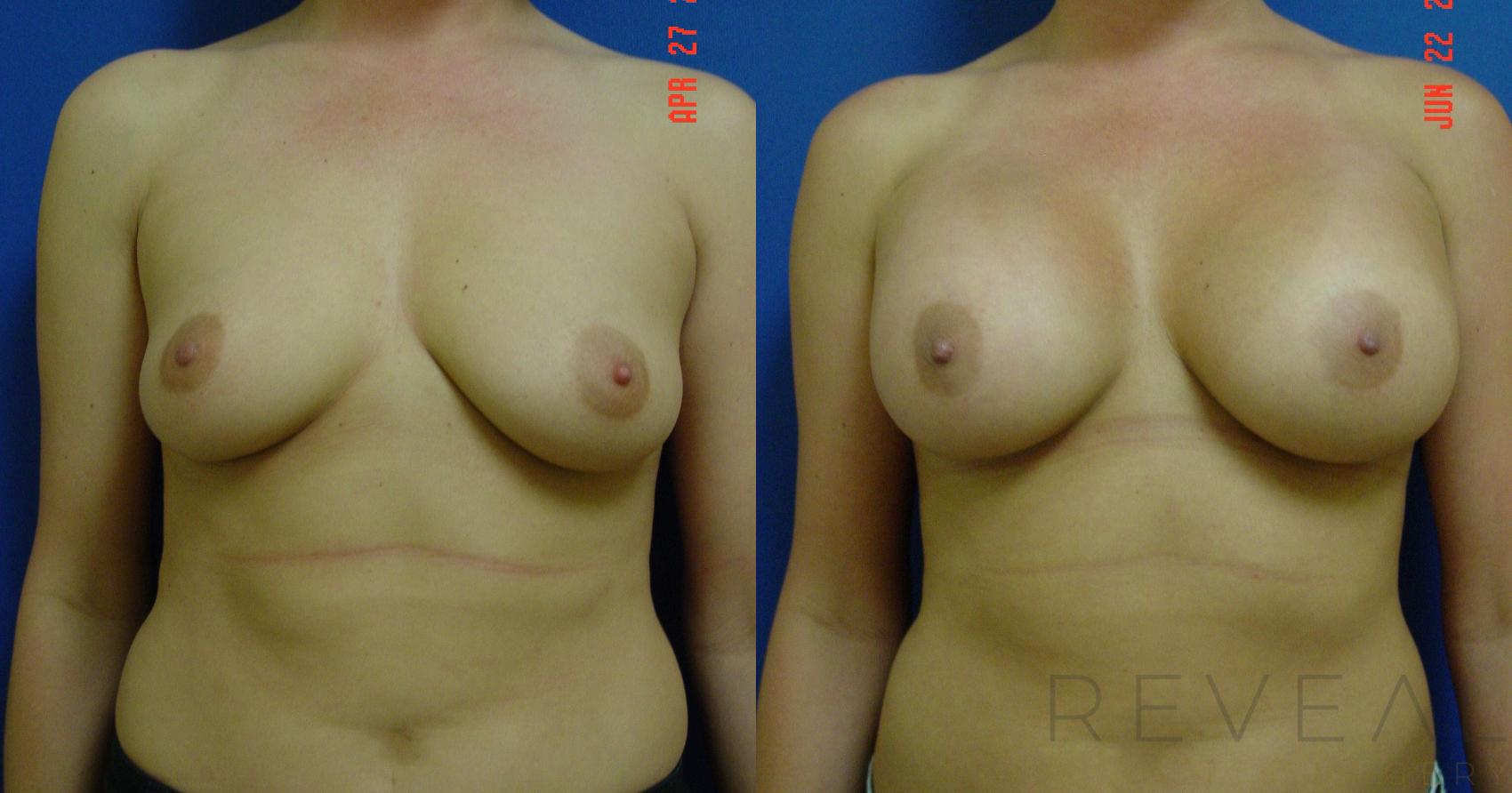 Before & After Breast Augmentation Case 74 View #1 View in San Jose, CA