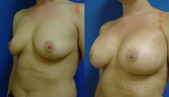 Before & After Breast Augmentation Case 74 View #2 View in San Jose, CA
