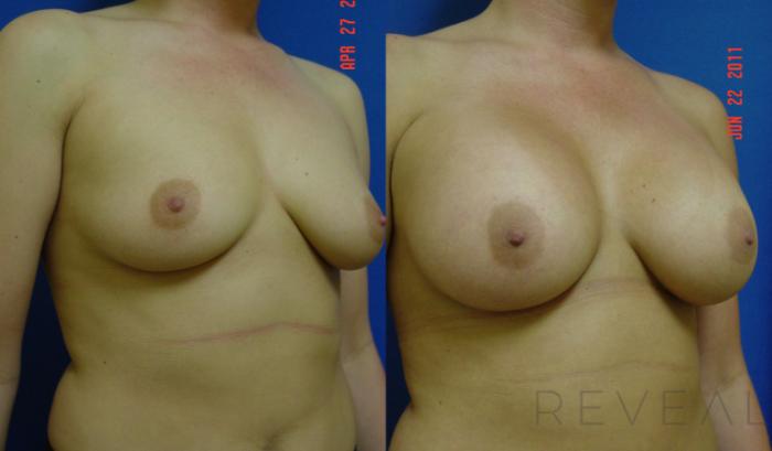 Before & After Breast Augmentation Case 74 View #3 View in San Jose, CA
