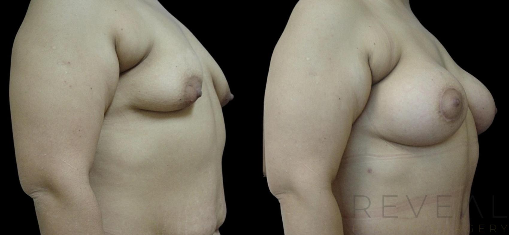 Before & After Breast Lift Case 741 Front View in San Jose, CA