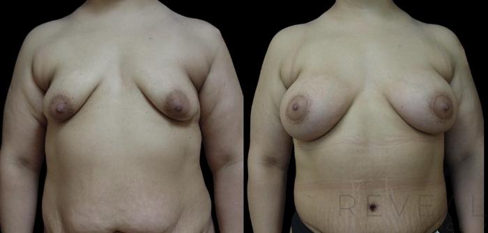 Before & After Breast Augmentation Case 741 Left Oblique View in San Jose, CA