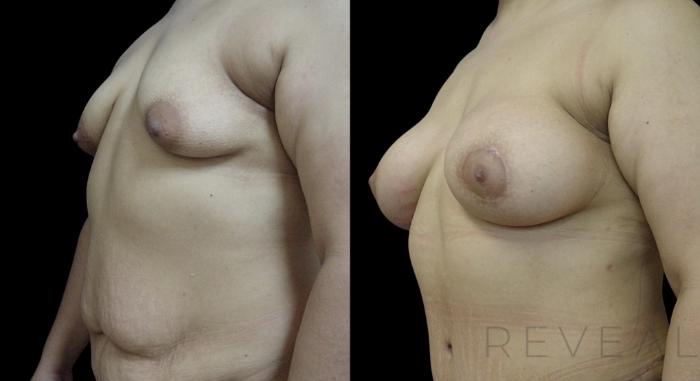 Before & After Breast Augmentation Case 741 Left Side View in San Jose, CA