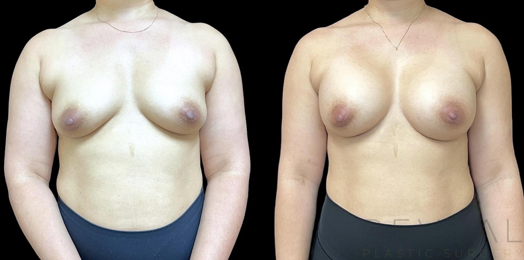 Before & After Breast Augmentation Case 744 Front View in San Jose, CA