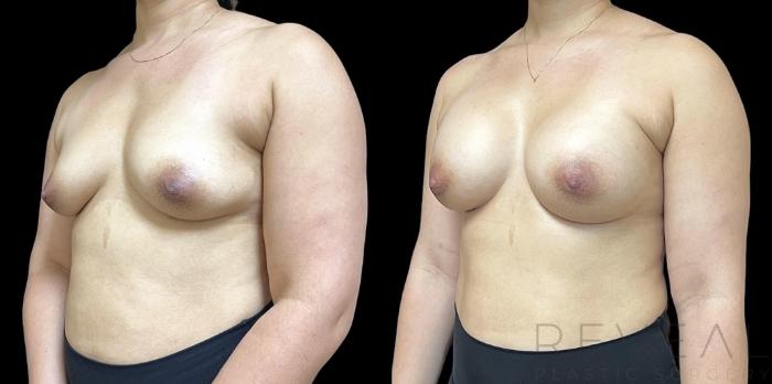 Before & After Breast Augmentation Case 744 Left Oblique View in San Jose, CA