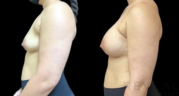 Before & After Breast Augmentation Case 744 Left Side View in San Jose, CA