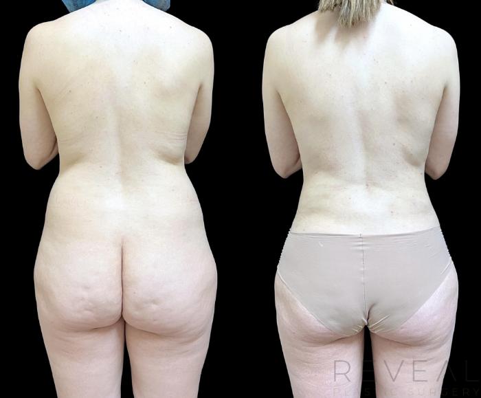 Before & After Breast Augmentation Case 745 Back View in San Jose, CA