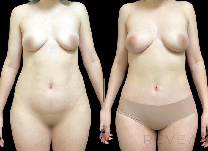 Before & After Fat Transfer to Breasts Case 745 Front View in San Jose, CA