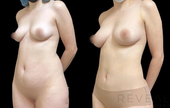 Before & After Fat Transfer to Breasts Case 745 Left Oblique View in San Jose, CA