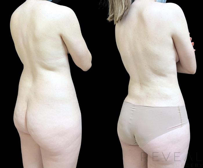 Before & After Breast Augmentation Case 745 Left Side View in San Jose, CA