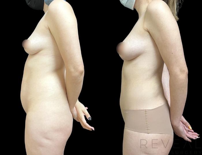 Before & After Fat Transfer to Breasts Case 745 Right Side View in San Jose, CA