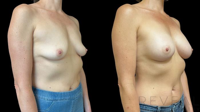 Before & After Breast Augmentation Case 756 Right Oblique View in San Jose, CA