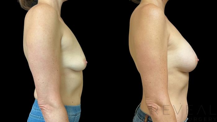 Before & After Breast Augmentation Case 756 Right Side View in San Jose, CA
