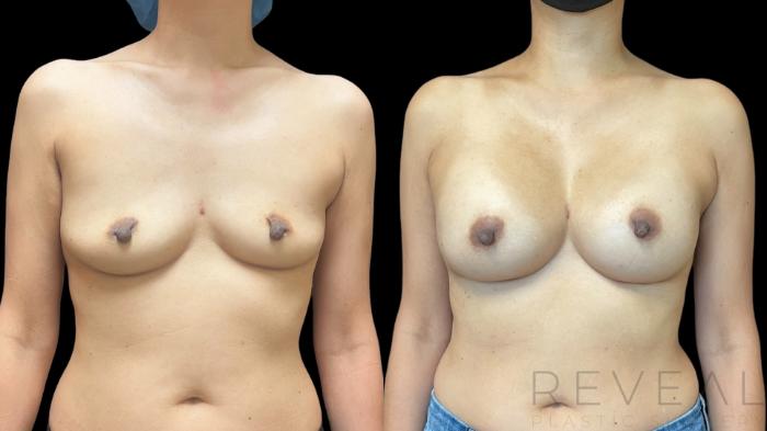 Before & After Breast Augmentation Case 758 Front View in San Jose, CA