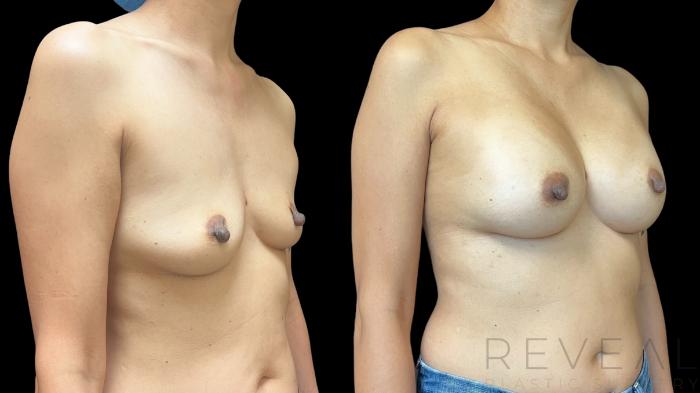 Before & After Breast Augmentation Case 758 Right Oblique View in San Jose, CA