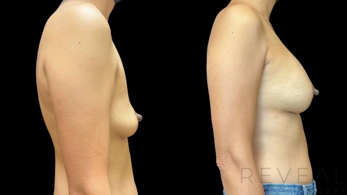 Before & After Breast Augmentation Case 758 Right Side View in San Jose, CA