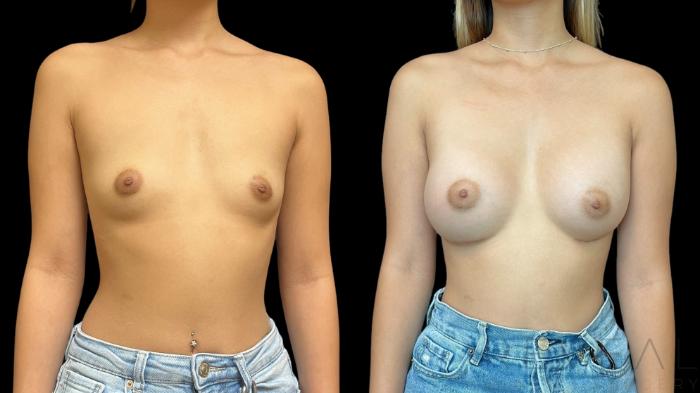 Before & After Breast Augmentation Case 760 Front View in San Jose, CA