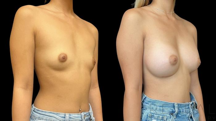 Before & After Breast Augmentation Case 760 Right Oblique View in San Jose, CA
