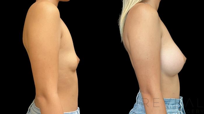 Before & After Breast Augmentation Case 760 Right Side View in San Jose, CA