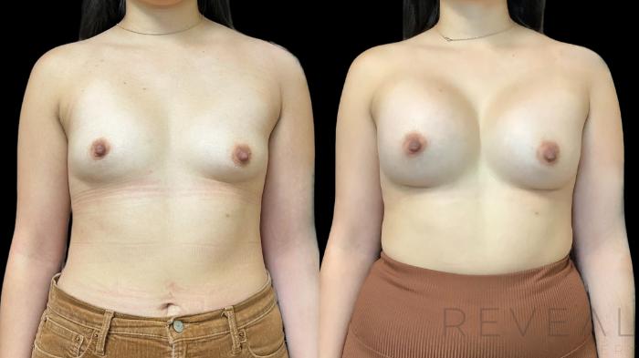 Before & After Breast Augmentation Case 761 Front View in San Jose, CA