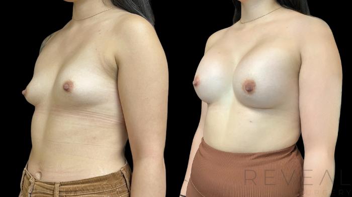 Before & After Breast Augmentation Case 761 Left Oblique View in San Jose, CA